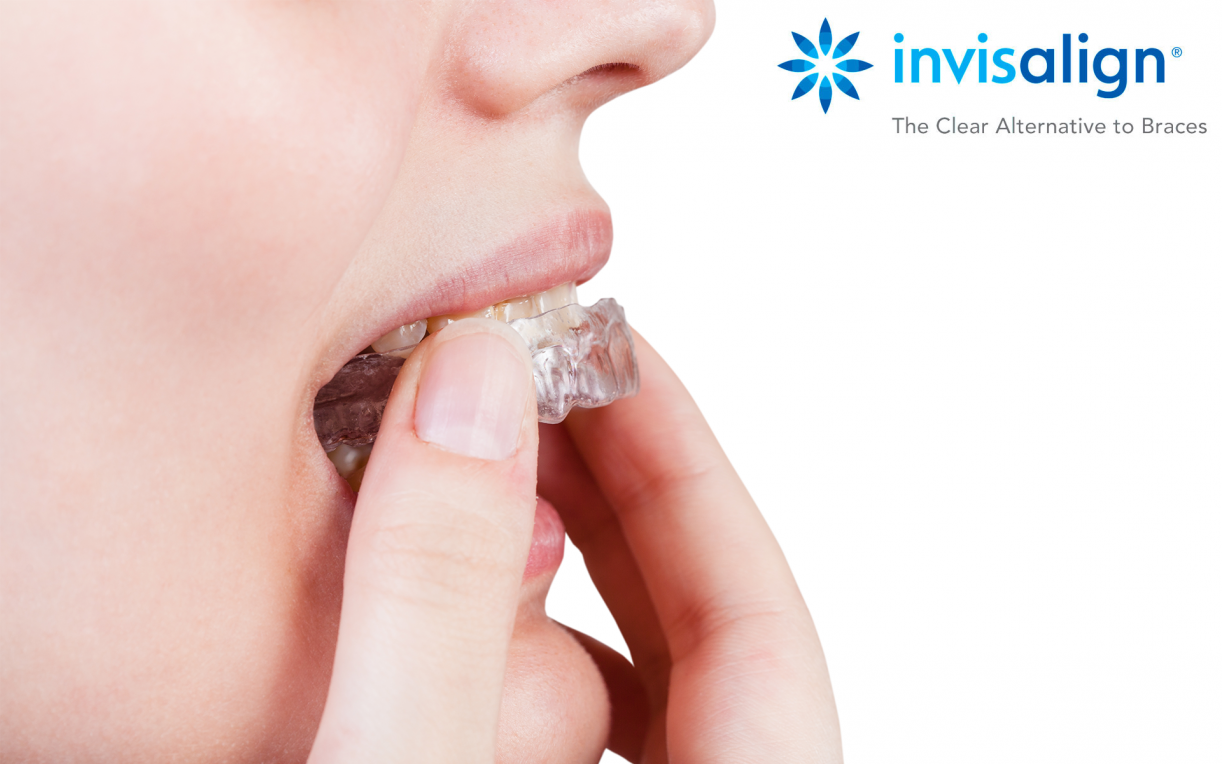 Clear Retainer in Glasgow with Invisalign